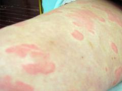 过敏性皮炎治与防